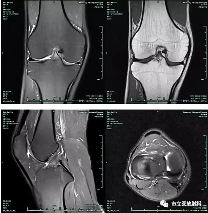 2膝關(guān)節(jié)MRI圖像_副本.jpg