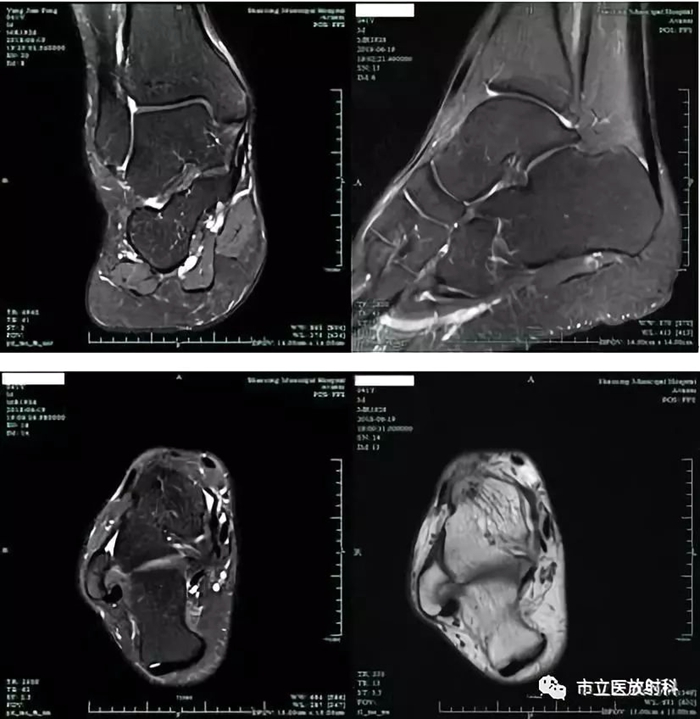 3裸關(guān)節(jié)MRI圖像_副本.jpg